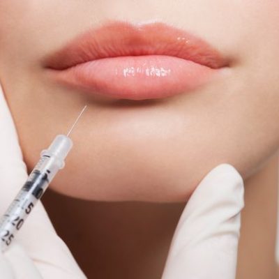 lip-fillers lip-fillers